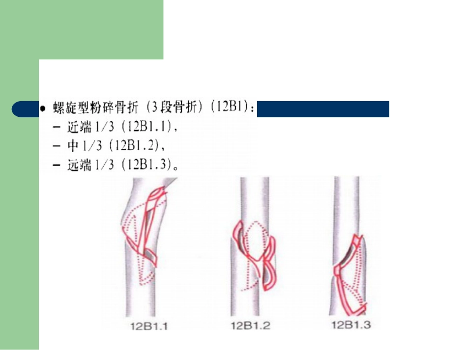 外科学：骨折分型_第11页