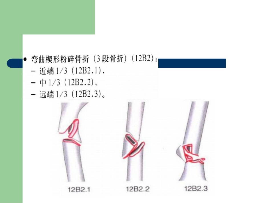 外科学：骨折分型_第12页