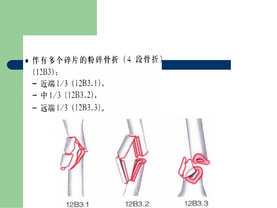 外科学：骨折分型_第13页