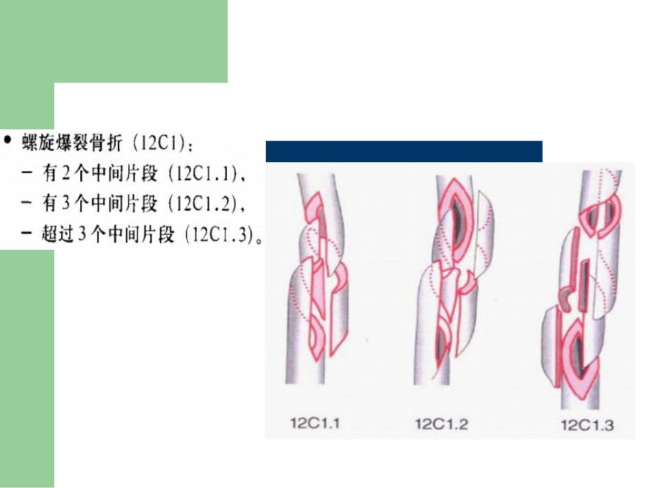 外科学：骨折分型_第14页