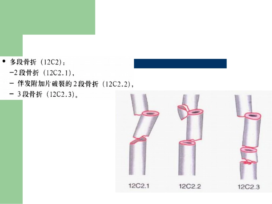 外科学：骨折分型_第15页