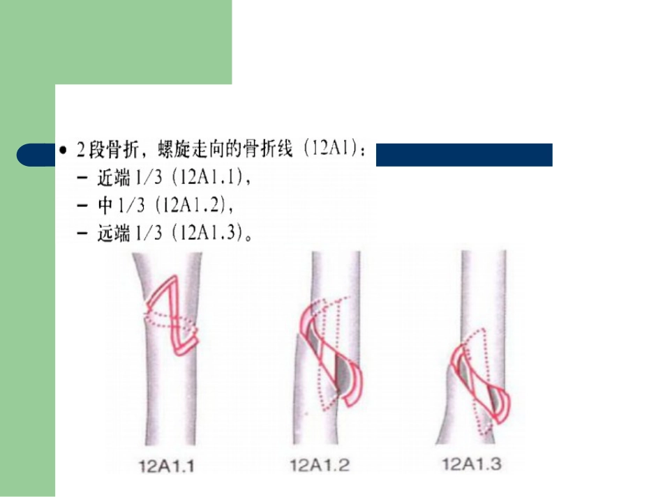 外科学：骨折分型_第8页