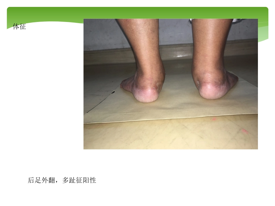外科学：胫后肌腱功能不全的诊治_第14页