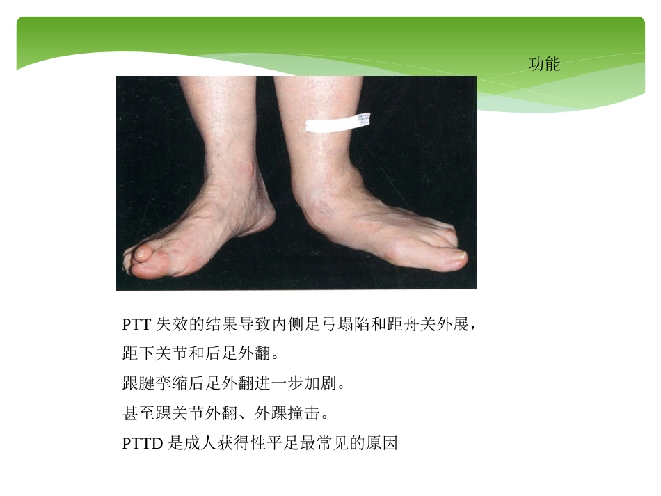 外科学：胫后肌腱功能不全的诊治_第9页