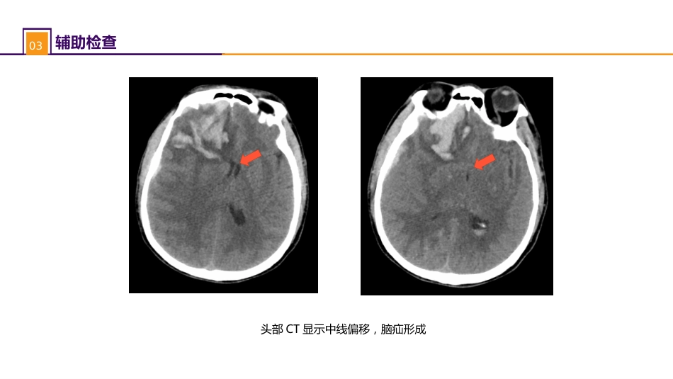外科学： 案例分析-脑疝_第6页
