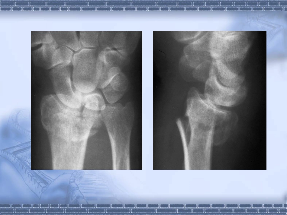 外科学：colles-fracture_第3页