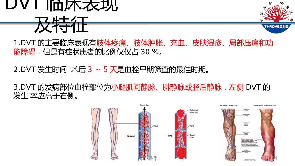 VTE预防与管理--ppt课件_第14页