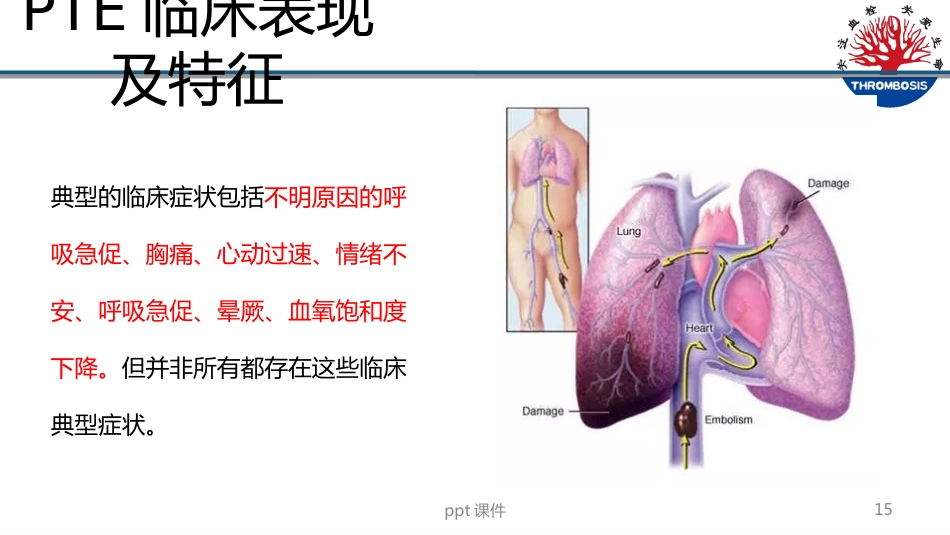 VTE预防与管理--ppt课件_第15页
