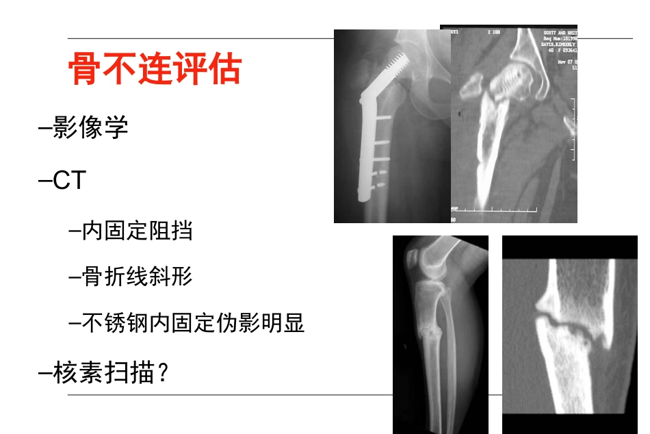 外科学：AO-骨不连和骨延迟愈合_第10页