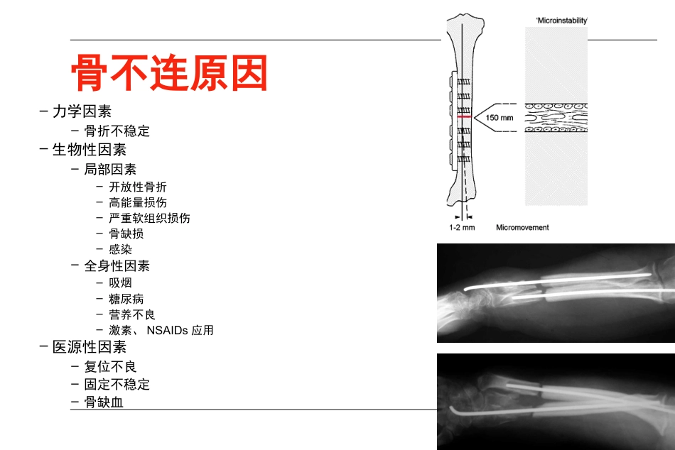 外科学：AO-骨不连和骨延迟愈合_第11页