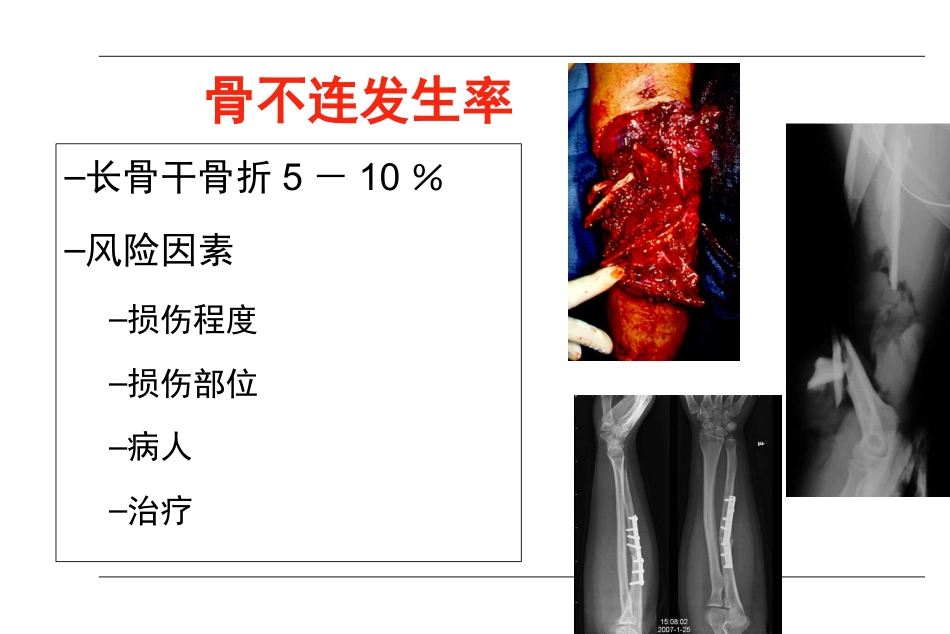 外科学：AO-骨不连和骨延迟愈合_第4页