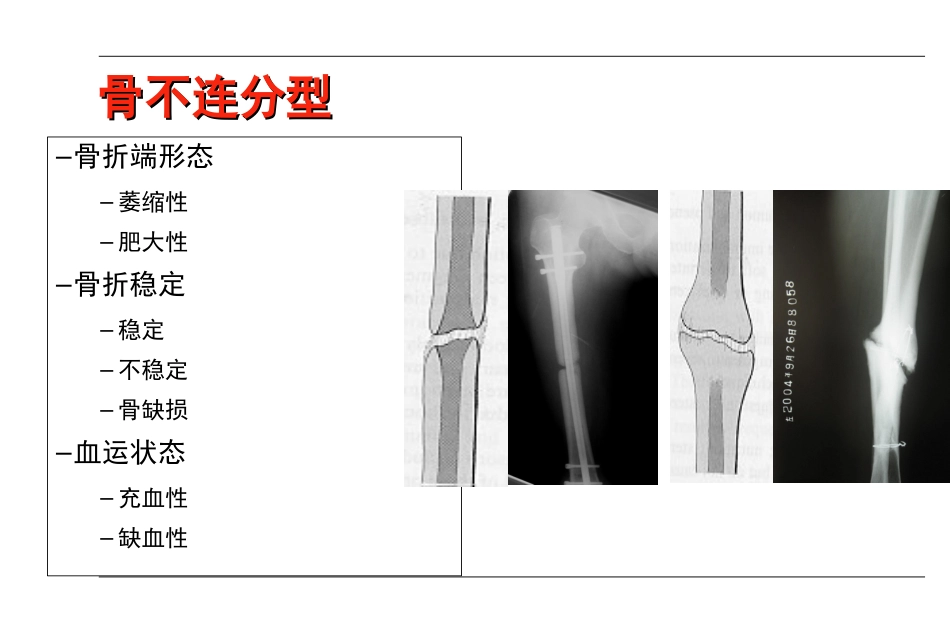 外科学：AO-骨不连和骨延迟愈合_第6页