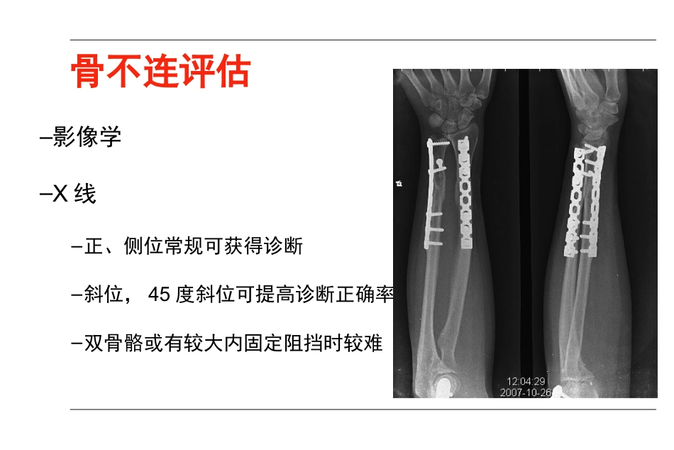 外科学：AO-骨不连和骨延迟愈合_第9页