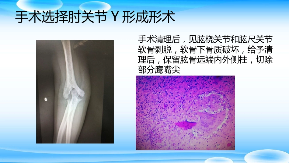 外科学：肘关节Y形成形术_第10页