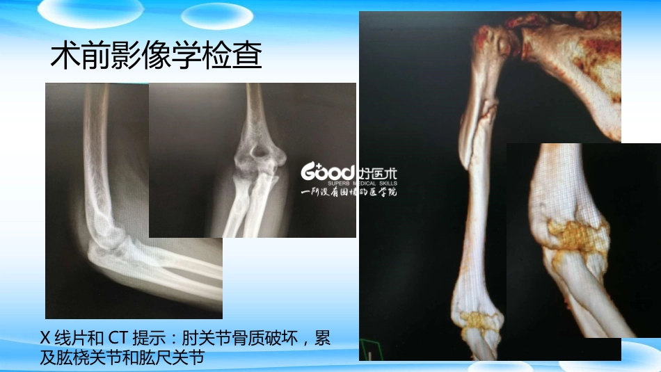 外科学：肘关节Y形成形术_第9页