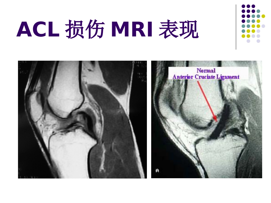 外科学：膝关节前交叉韧带损伤诊断与治疗_第11页