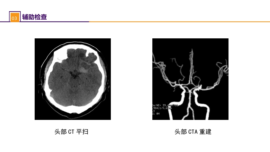 外科学：案例分析-颅内动脉瘤破裂导致的蛛网膜下腔出血_第6页