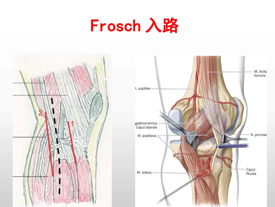 外科学：胫骨平台后外侧4种入路解剖观察_第12页