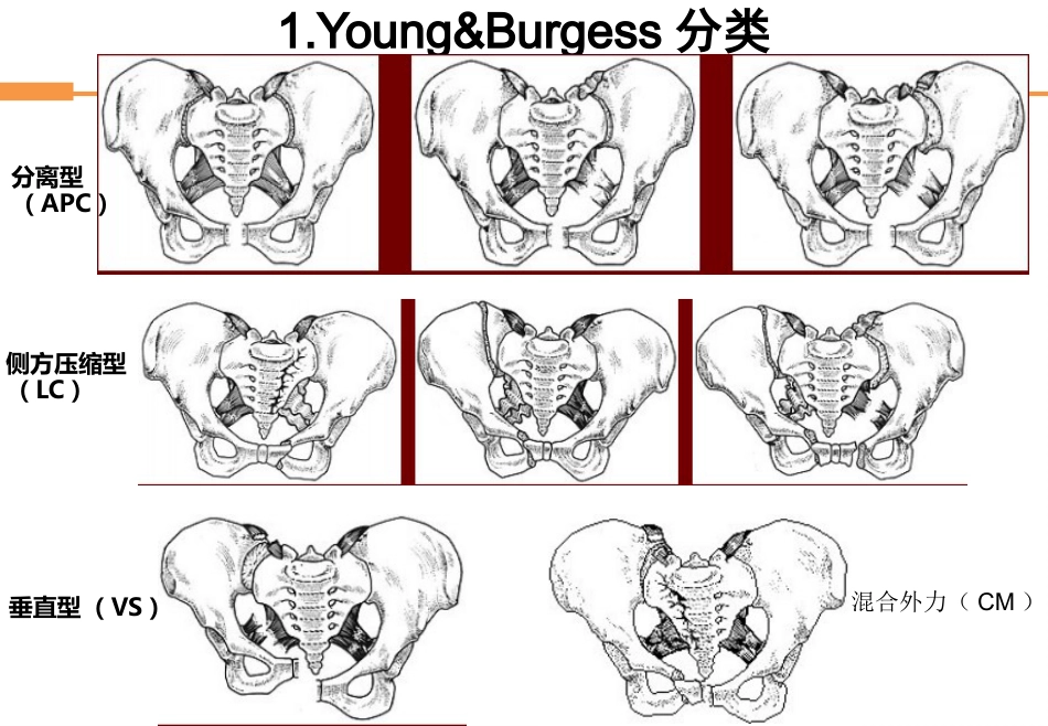 外科学：骨盆骨折_第10页