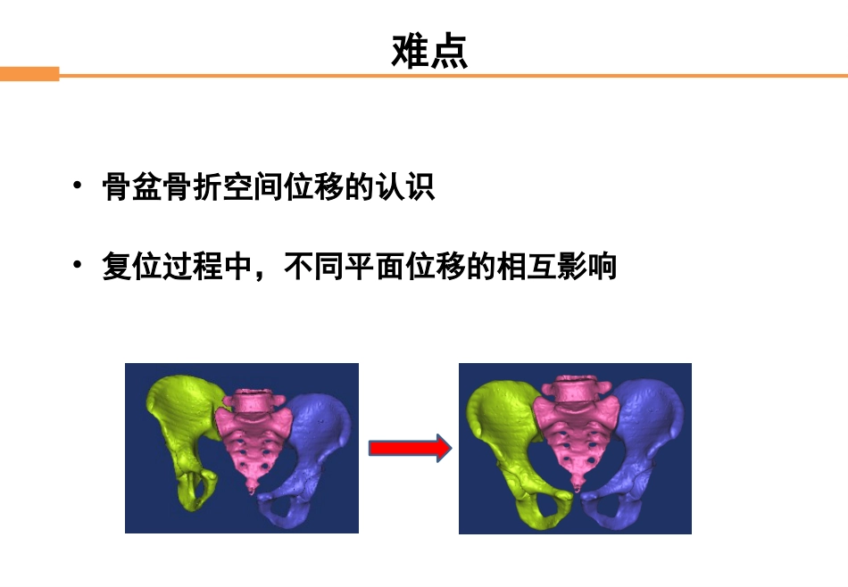 外科学：骨盆骨折_第13页