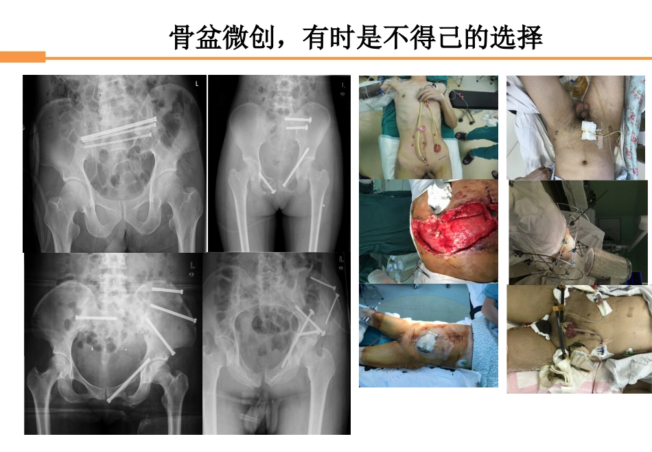 外科学：骨盆骨折_第8页