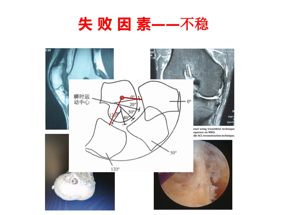 外科学：ACL重建失败原因分析_第6页
