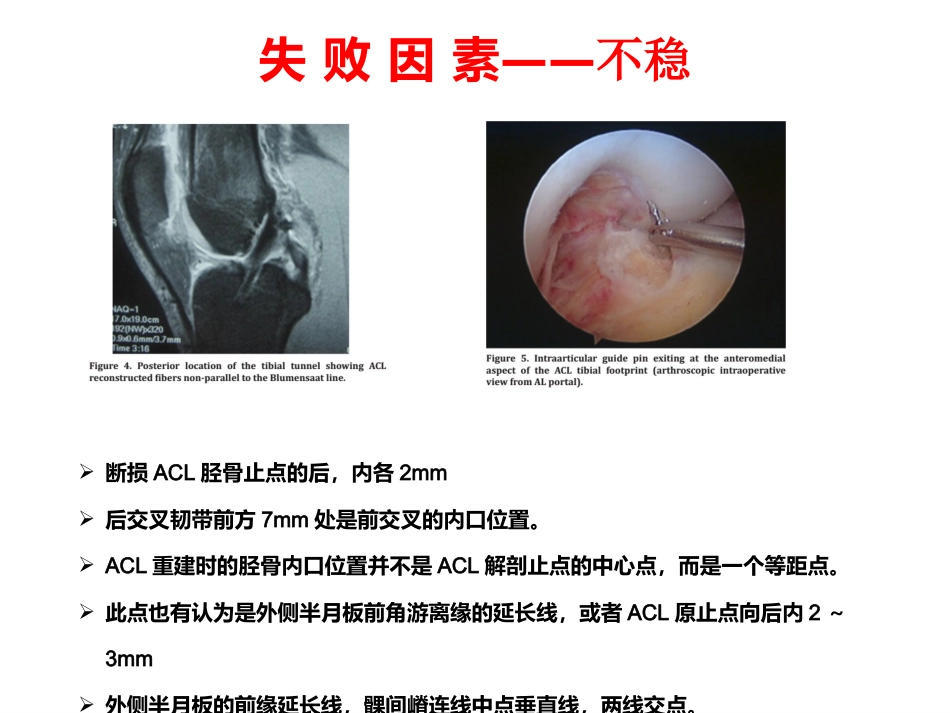 外科学：ACL重建失败原因分析_第8页