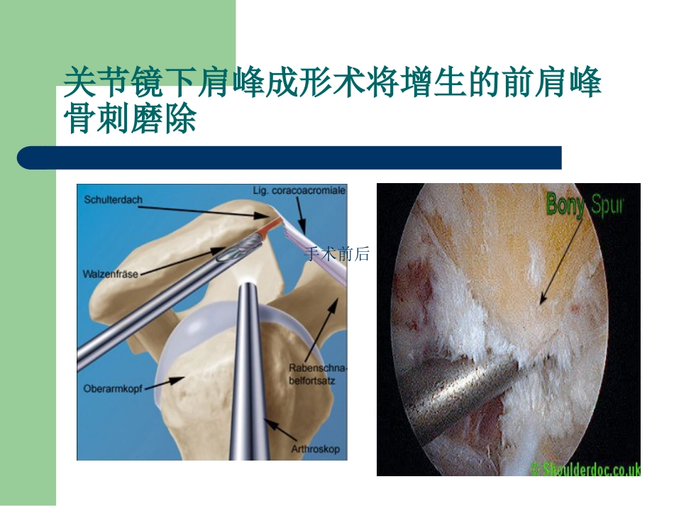 外科学：肩峰下撞击综合征_第15页