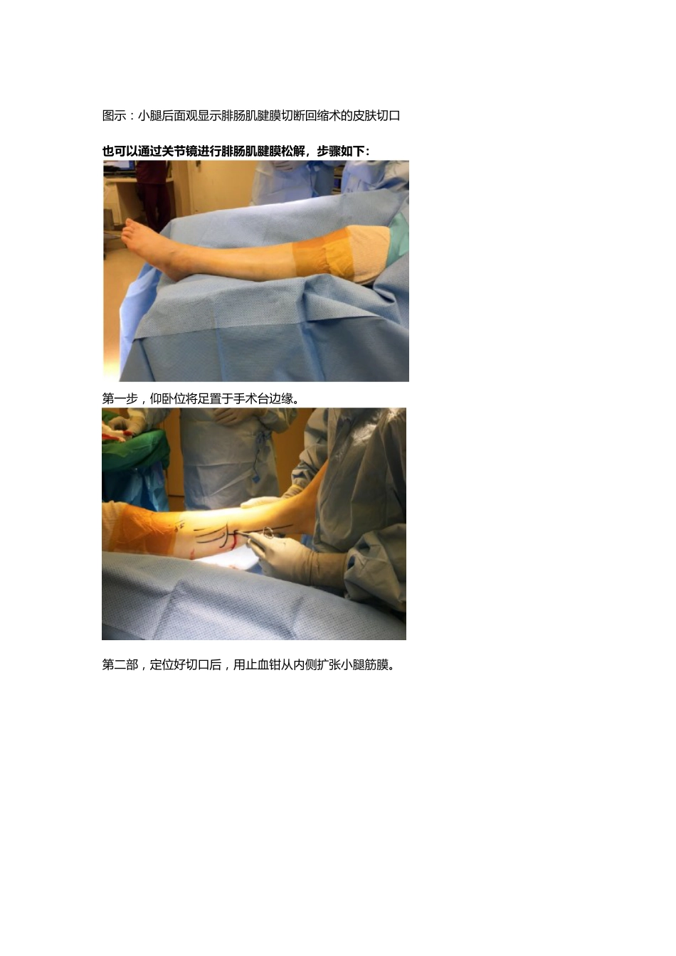 外科学：腓肠肌腱膜松解_第3页