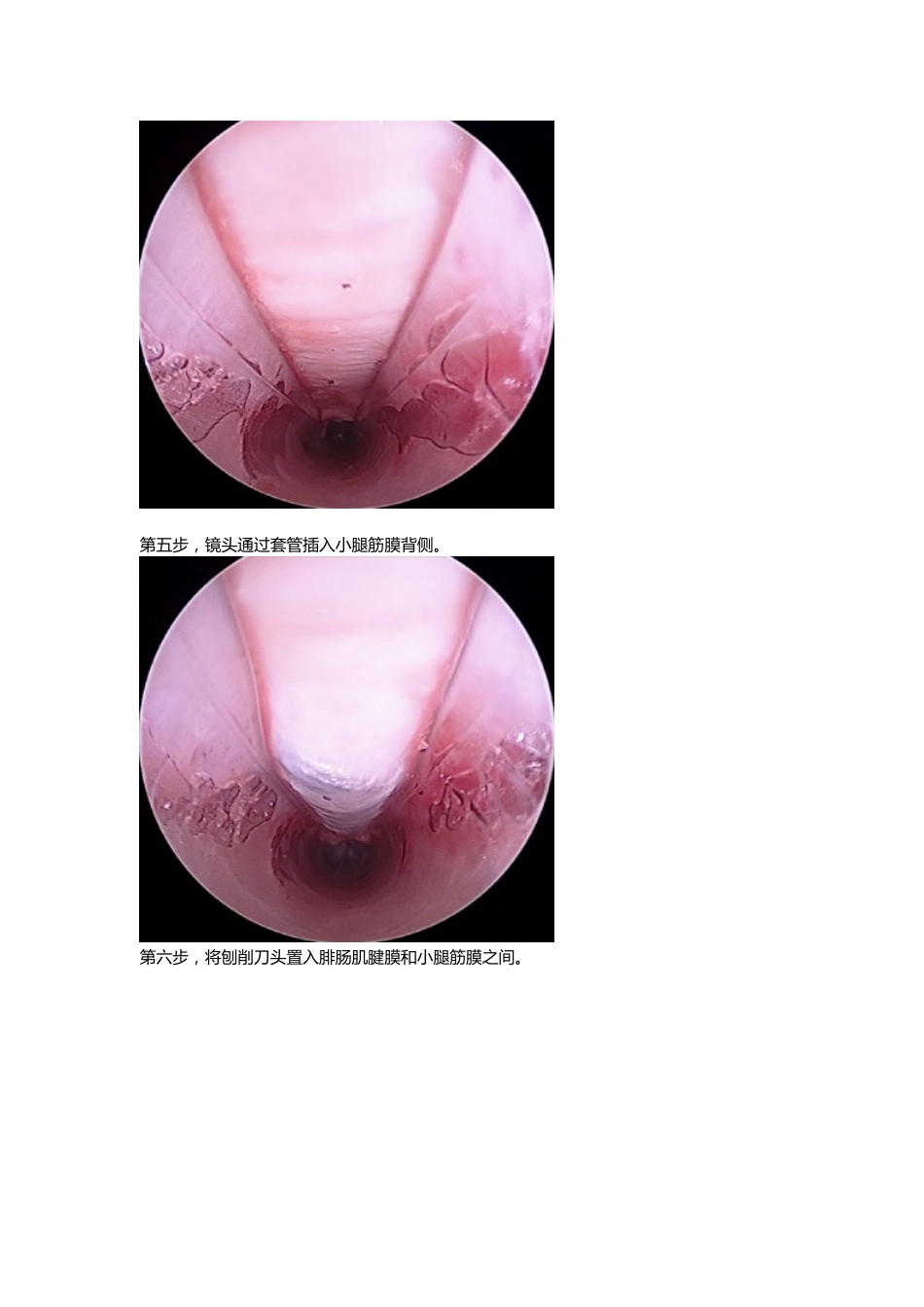 外科学：腓肠肌腱膜松解_第5页