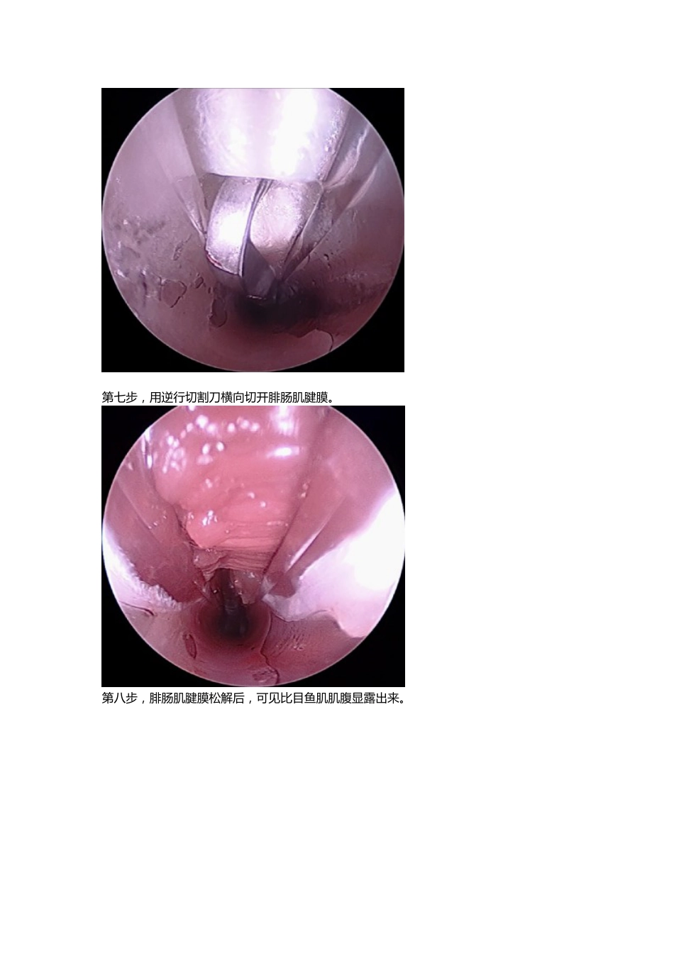 外科学：腓肠肌腱膜松解_第6页