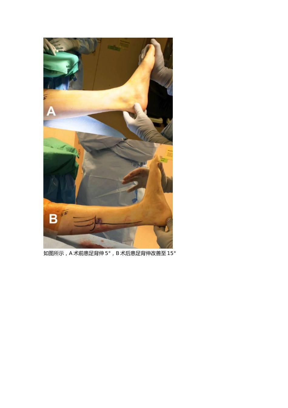 外科学：腓肠肌腱膜松解_第7页