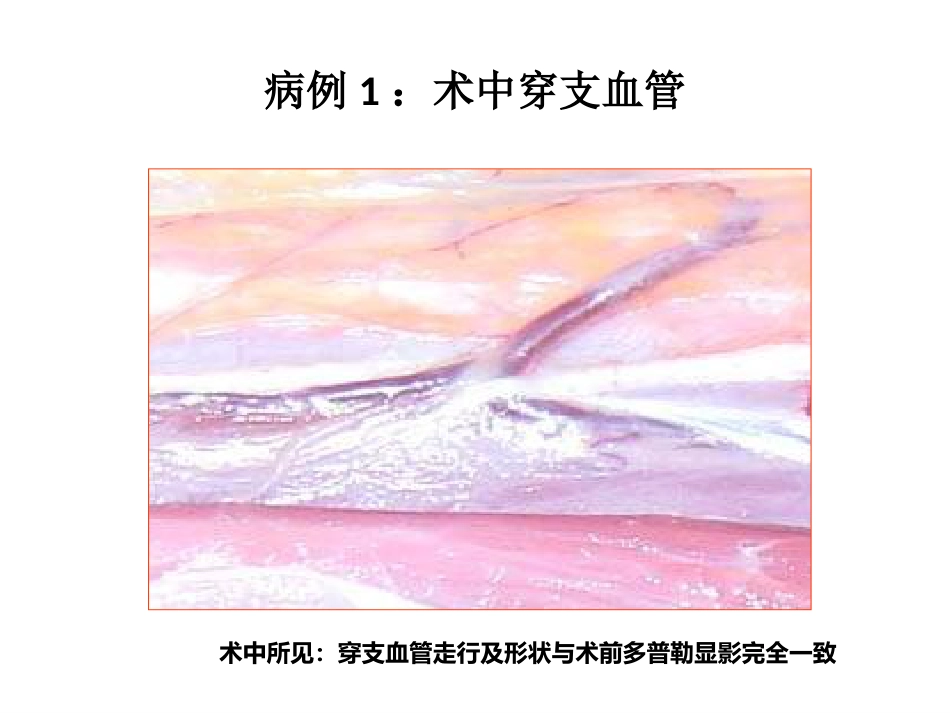 外科学：小腿穿支皮瓣的临床应用_第13页