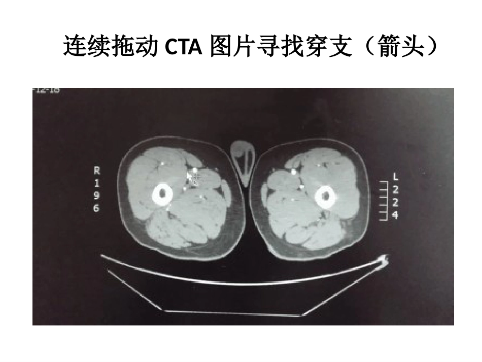 外科学：小腿穿支皮瓣的临床应用_第14页