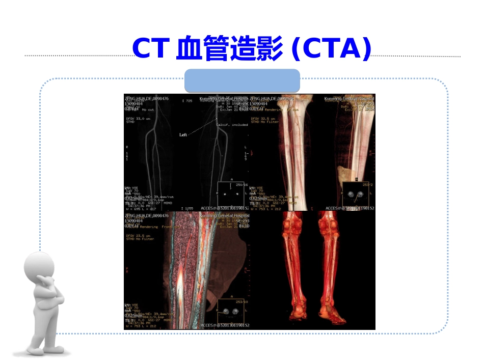外科学：小腿穿支皮瓣的临床应用_第15页