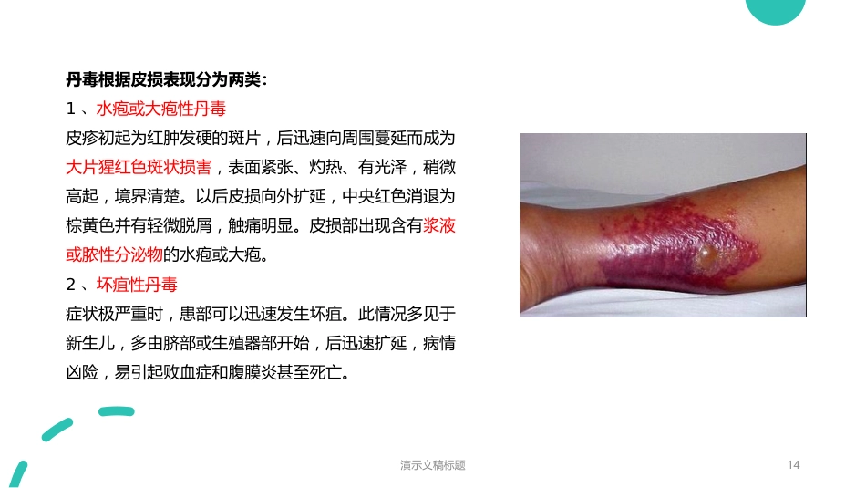 一例丹毒患者的病例讨论_第14页