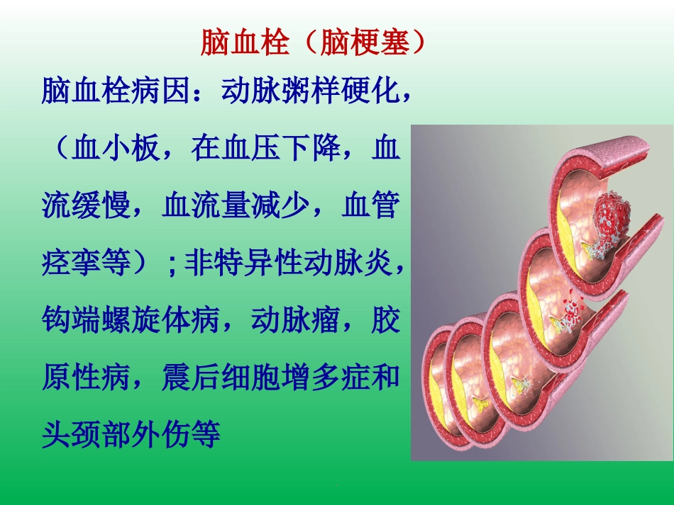 脑卒中的症状识别及院前急救_第15页
