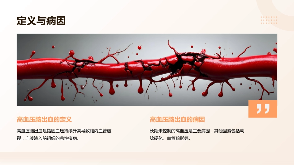 高血压脑出血的急救与护理课件_第4页