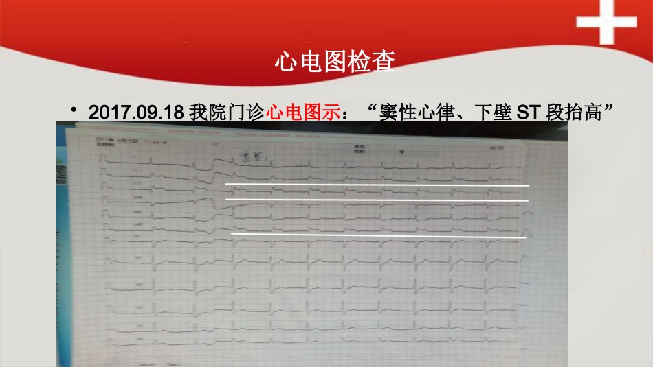 急性心肌梗死病例讨论_第4页