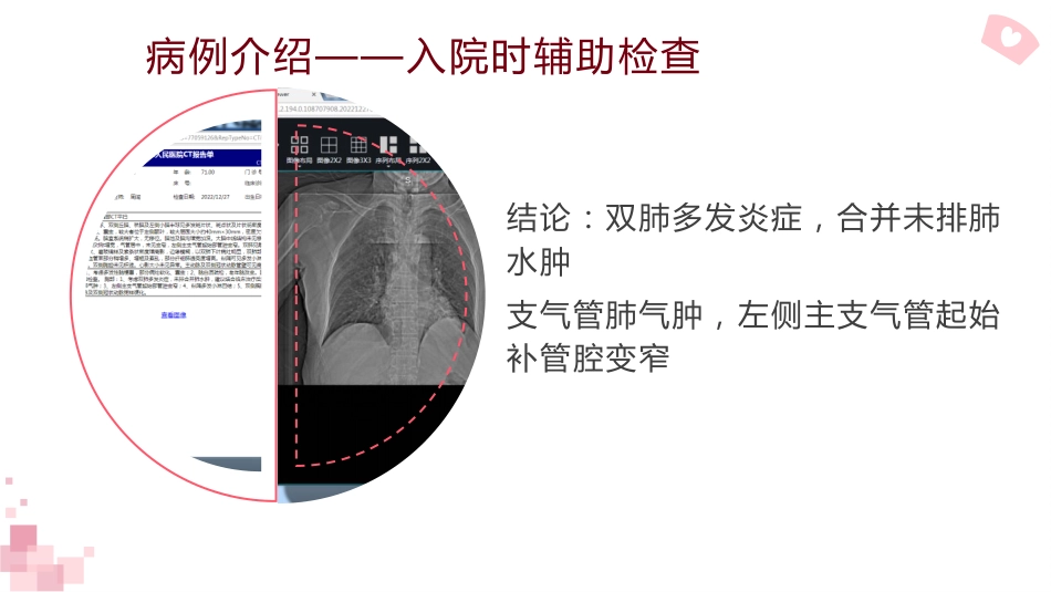 一例重症肺炎并发呼吸衰竭患者的经典案例_第13页