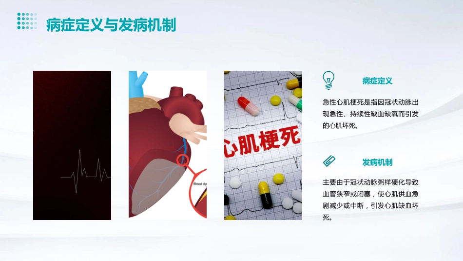 急性心肌梗死的急救与护理PPT课件_第4页