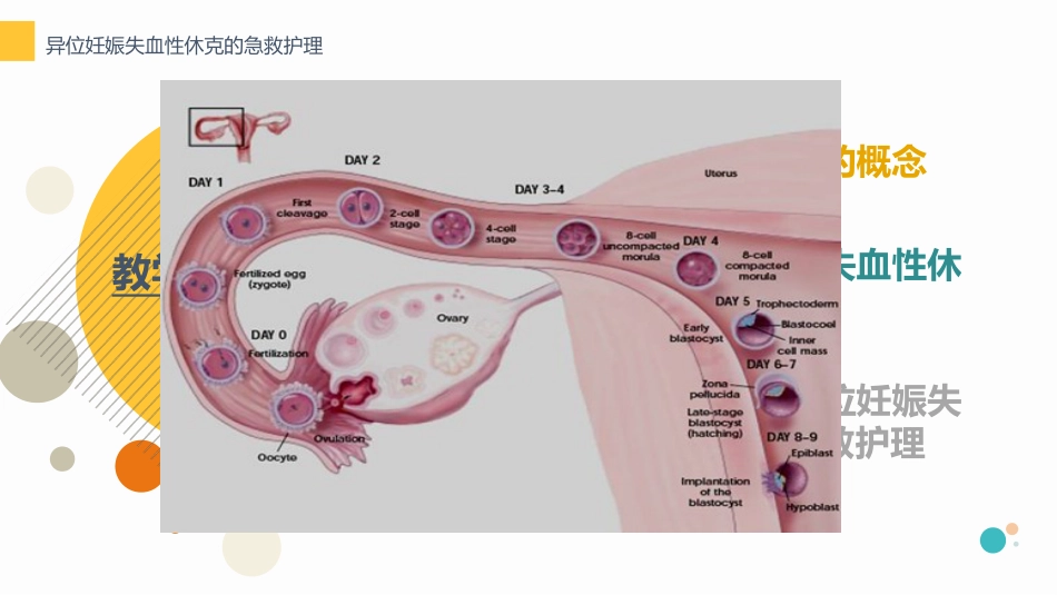 ZX异位妊娠失血性休克急救护理_第2页