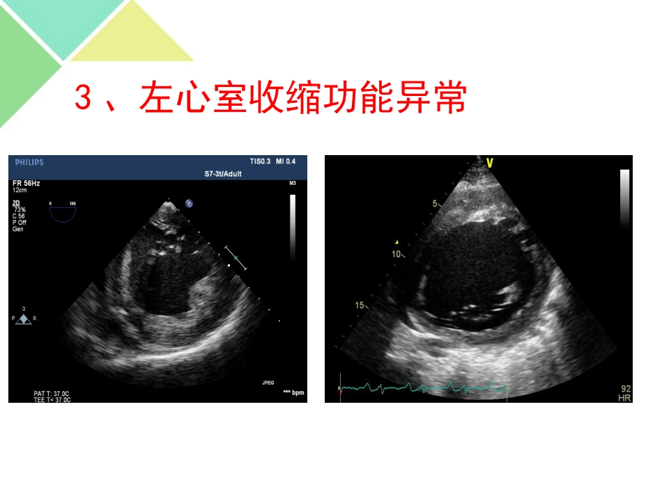 超声可视化技术在急诊急救中的应用_第14页