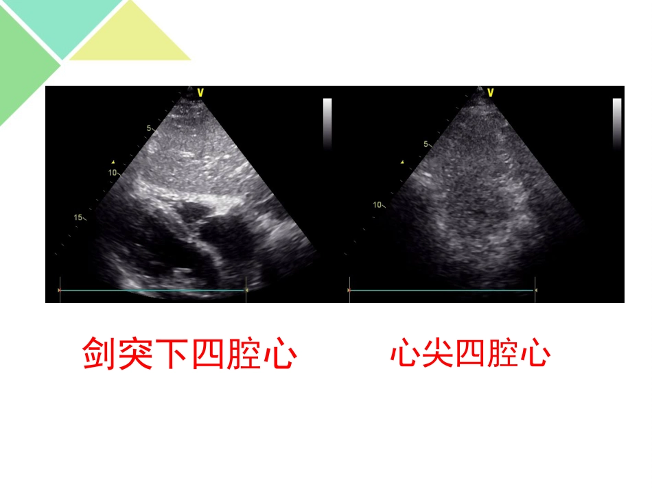 超声可视化技术在急诊急救中的应用_第6页