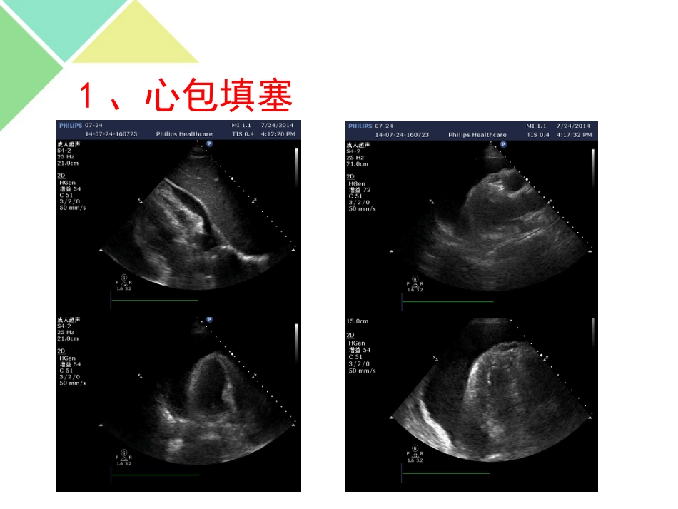 超声可视化技术在急诊急救中的应用_第9页