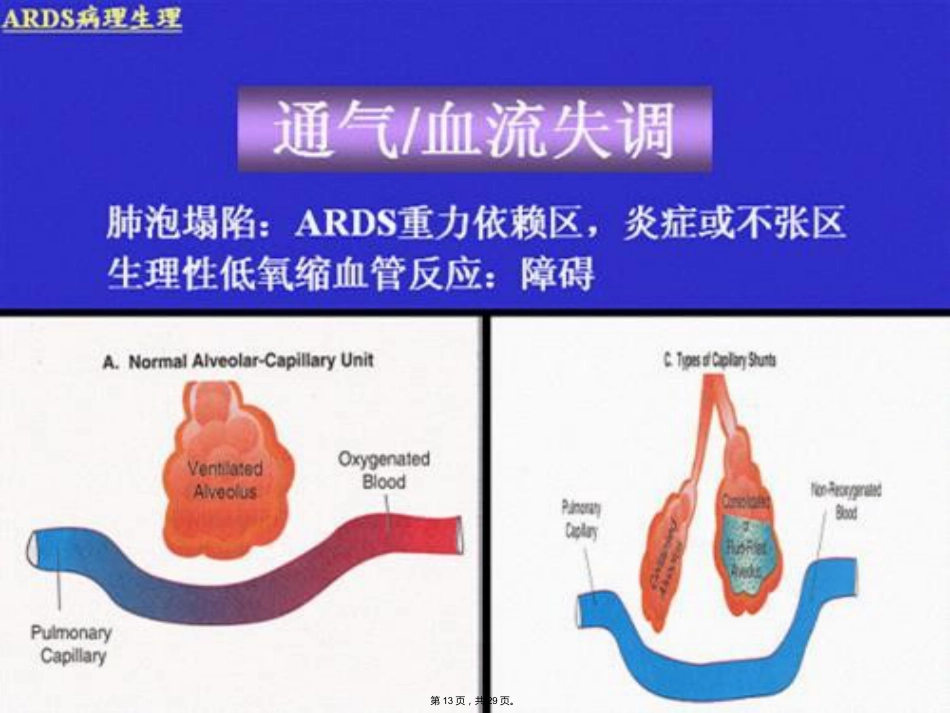 成人呼吸综合征急救ARDS_第13页