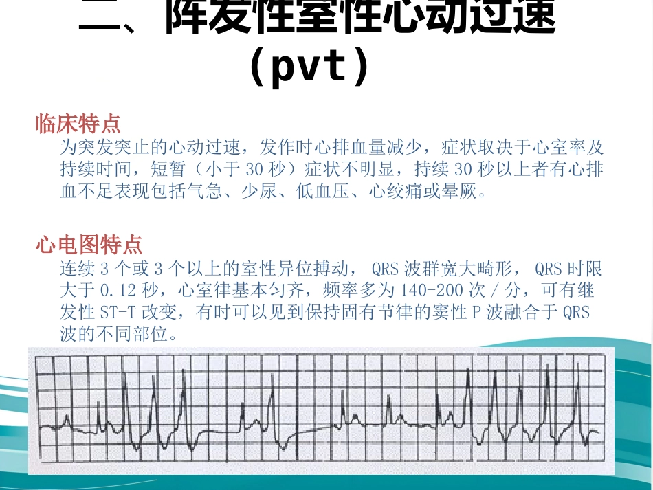 常见心律失常及急救护理课件_第11页