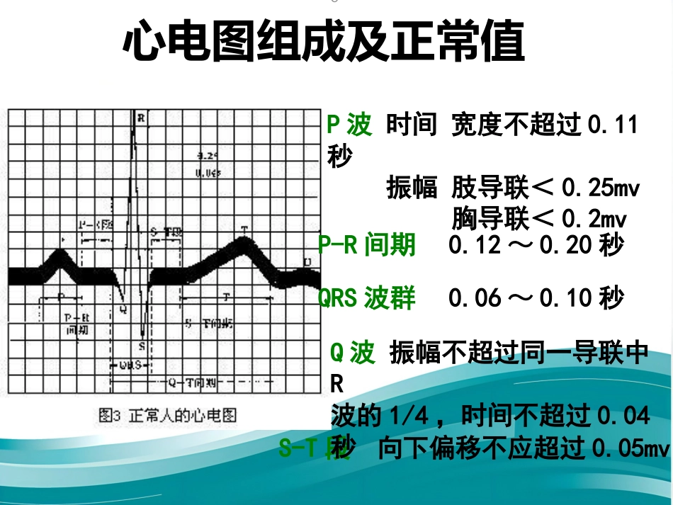 常见心律失常及急救护理课件_第5页