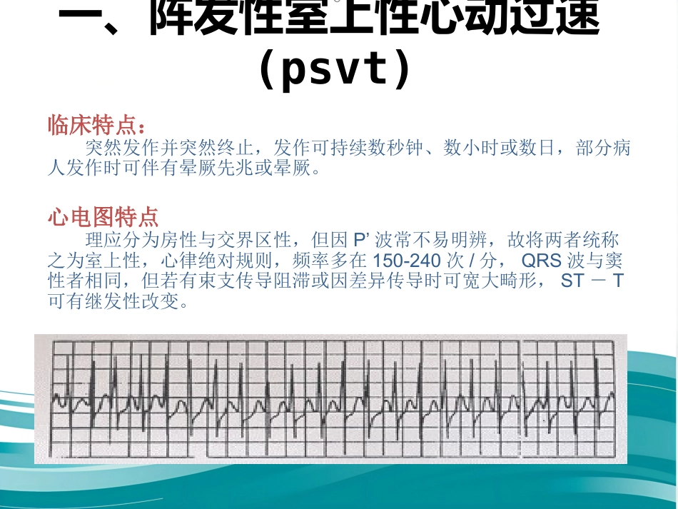 常见心律失常及急救护理课件_第8页