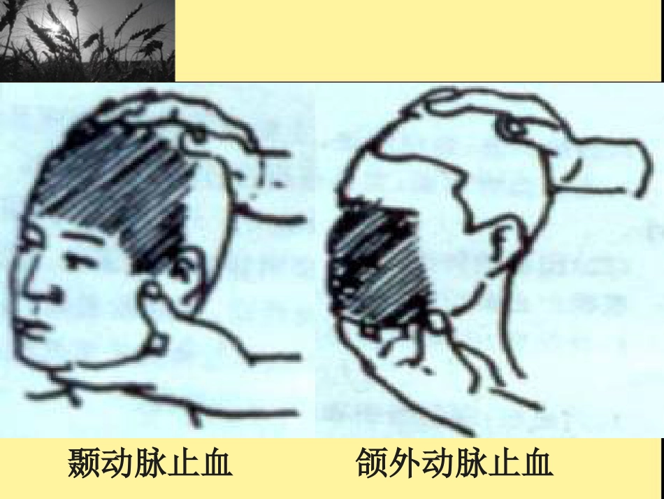 创伤现场急救_第13页